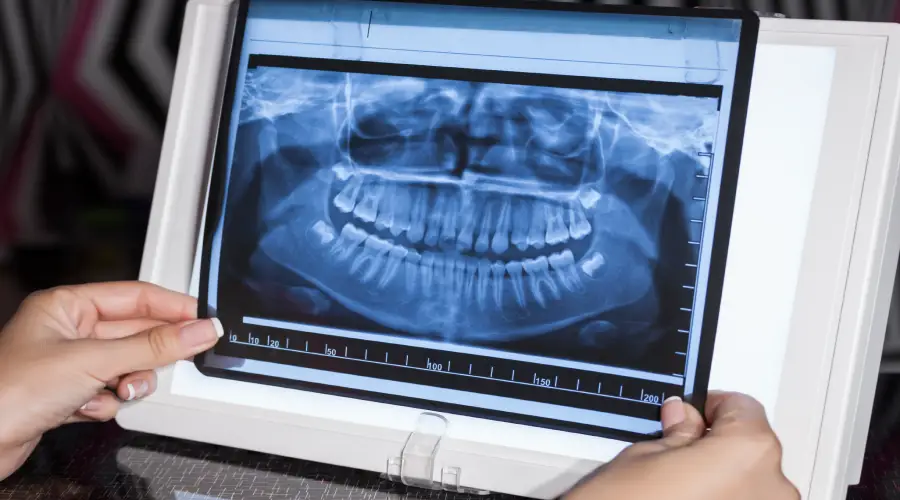 dental-x-rays-type