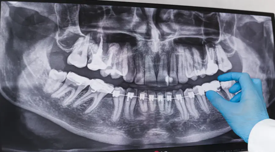 dental-x-rays