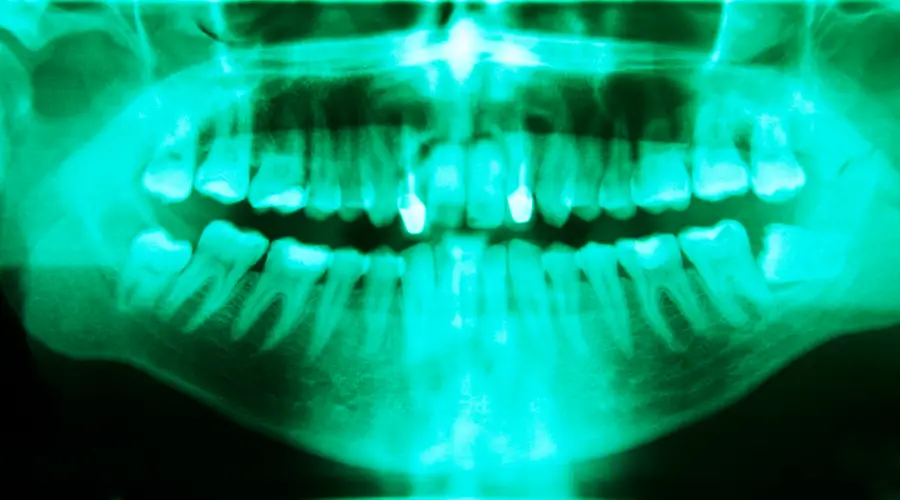 what-are-dental-x-rays